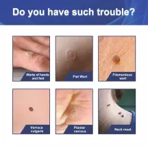 Jaysuing Skin Tag Patech - 144 Patech