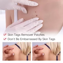 Jaysuing Skin Tag Remover and Repair Set