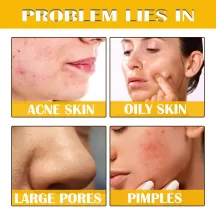 Jaysuing Peeling Serum Acne Removal