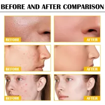 Jaysuing Peeling Serum Acne Removal