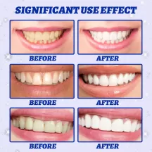 Jaysuing 5D Gel Teeth Whitening