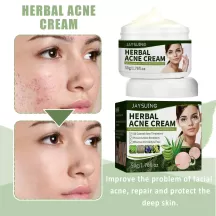 Jaysuing Herbal Acne Removing Cream