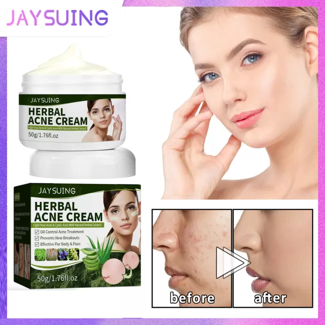 Jaysuing Herbal Acne Removing Cream