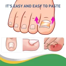 Jaysuing Nail Correction Stickers Ingrown Toenail Patche