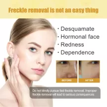 Jaysuing Freckle Removal Cream Dark Spot