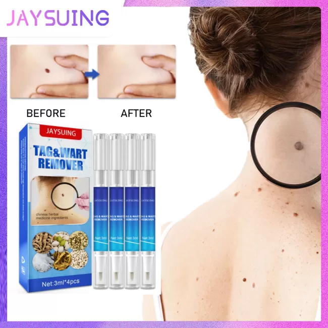 Jaysuing Wart Remover Skin Tag Removal Pen