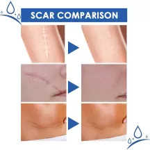 Jaysuing Scar Removal Cream Stretch Marks