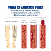 Jaysuing Varicose Vein Cream