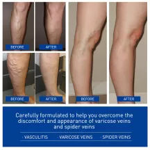 Jaysuing Varicose Vein Cream