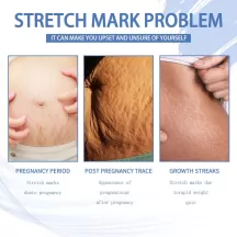 Jaysuing Stretch Mark Removal Cream