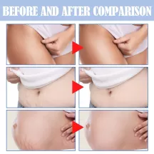 Jaysuing Stretch Mark Removal Cream