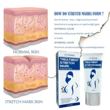 Jaysuing Stretch Mark Removal Cream